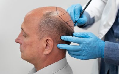 Haartransplantatie kruin: de oplossing voor een kalende kruin