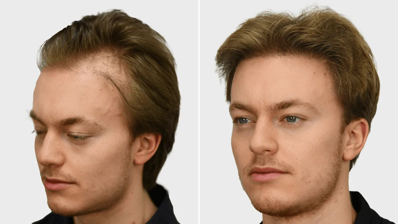 j reiprich voor en na.png links