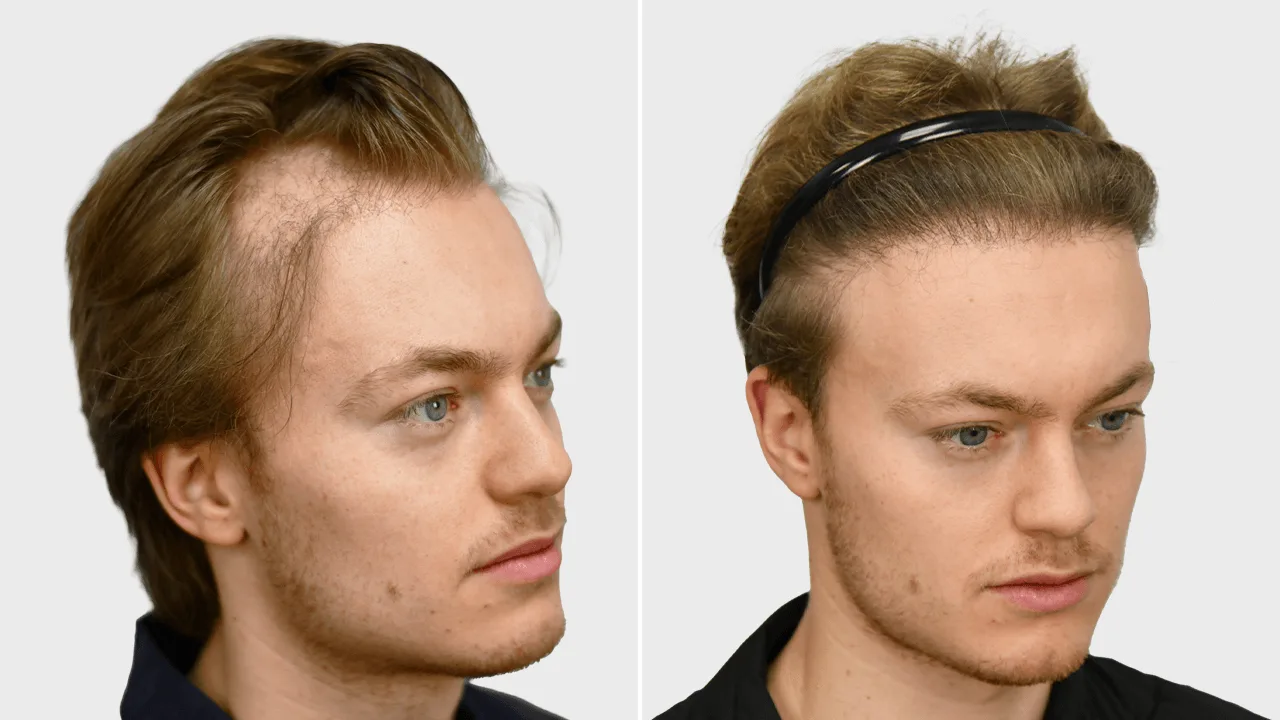 j reiprich voor en na.png rechts