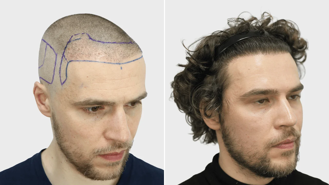 p bosma voor en na rechts