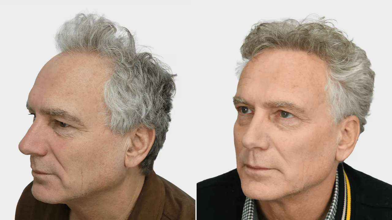 p de lange voor en na rechts