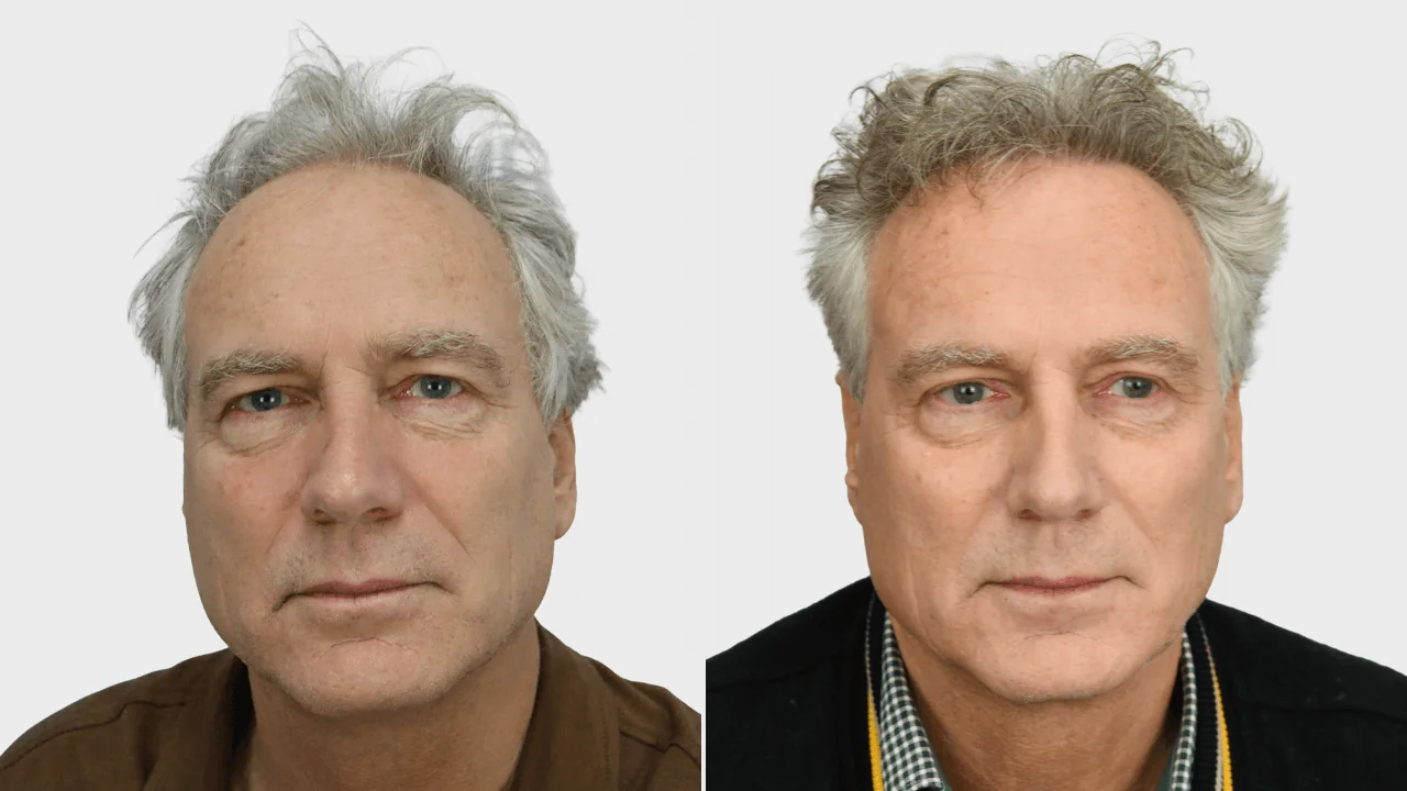p de lange voor en na voorkant
