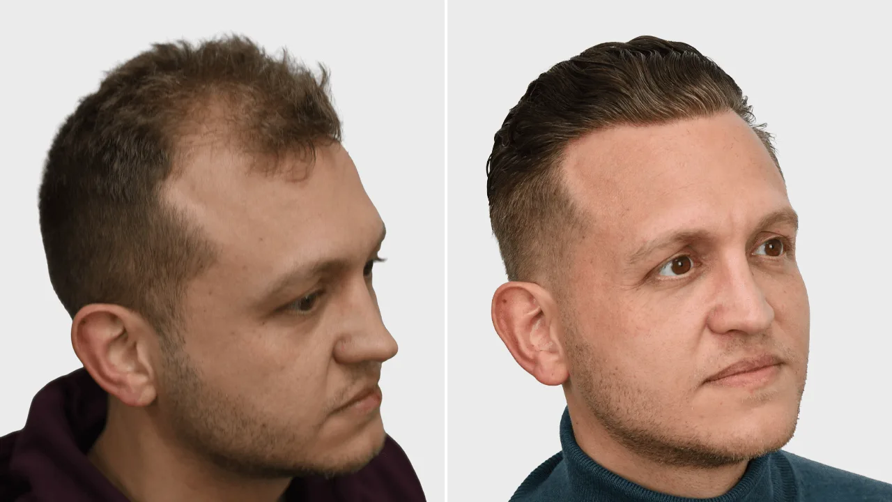 s baars voor en na rechts