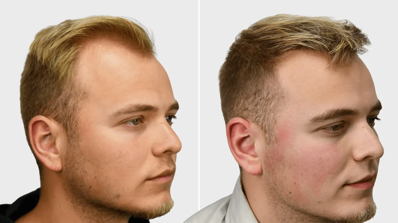 t goot voor en na rechts