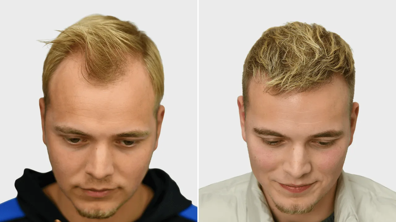 t goot voor en na voorkant