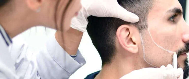 baard en snor transplantatie behandeling