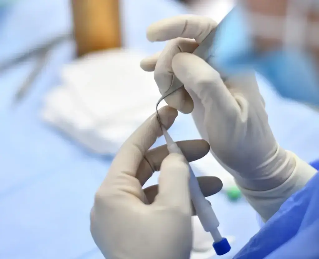 Behandelaar met een implanteerpen in de hand tijdens een haartransplantatie