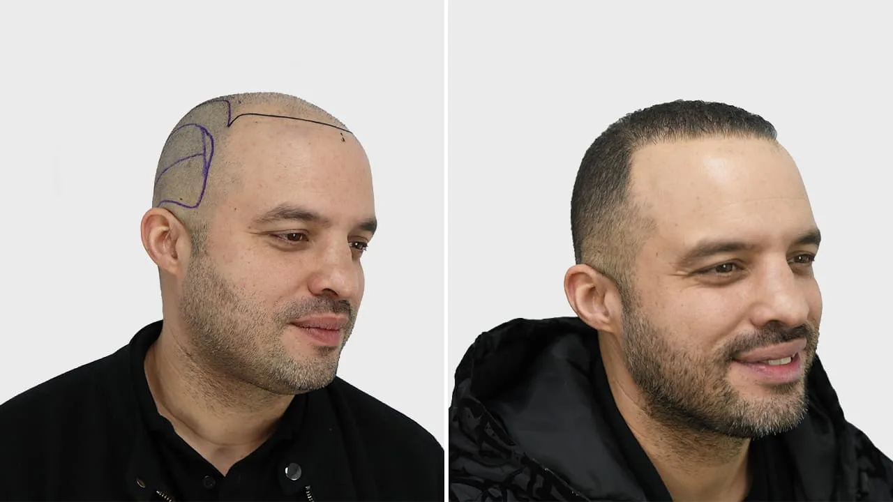 g heij voor en na rechts