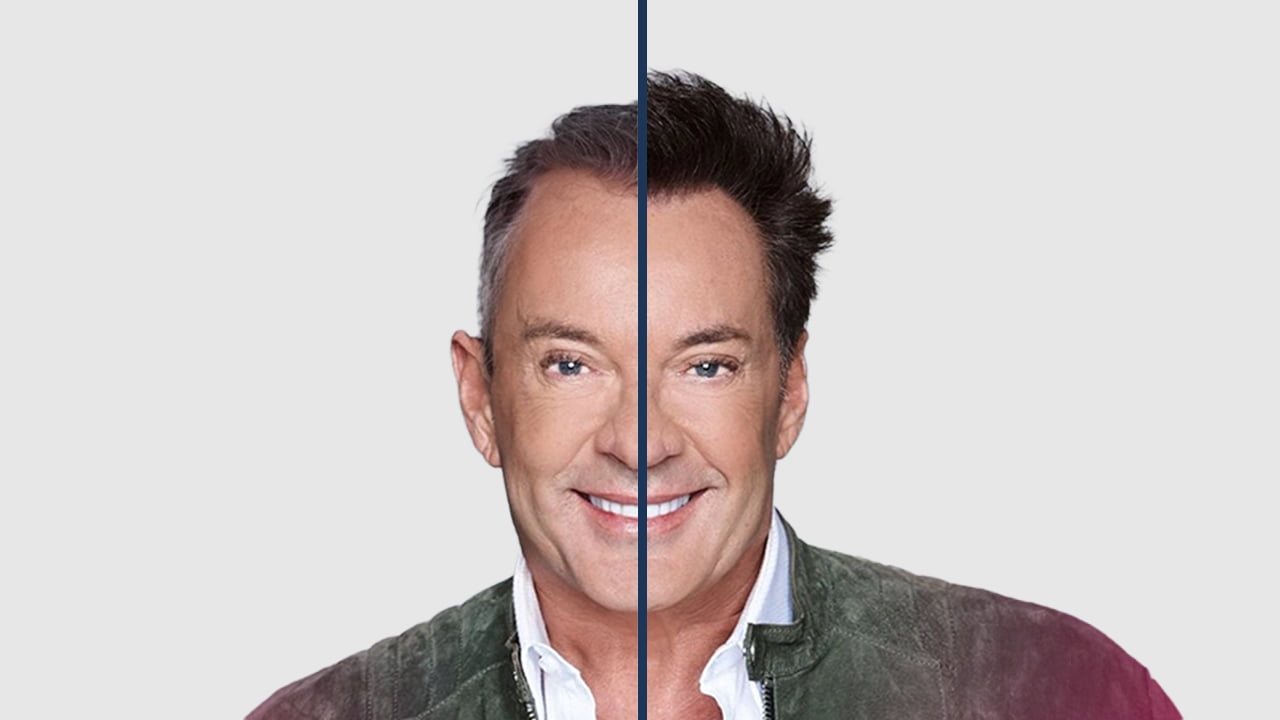 gerard joling haartransplantatie