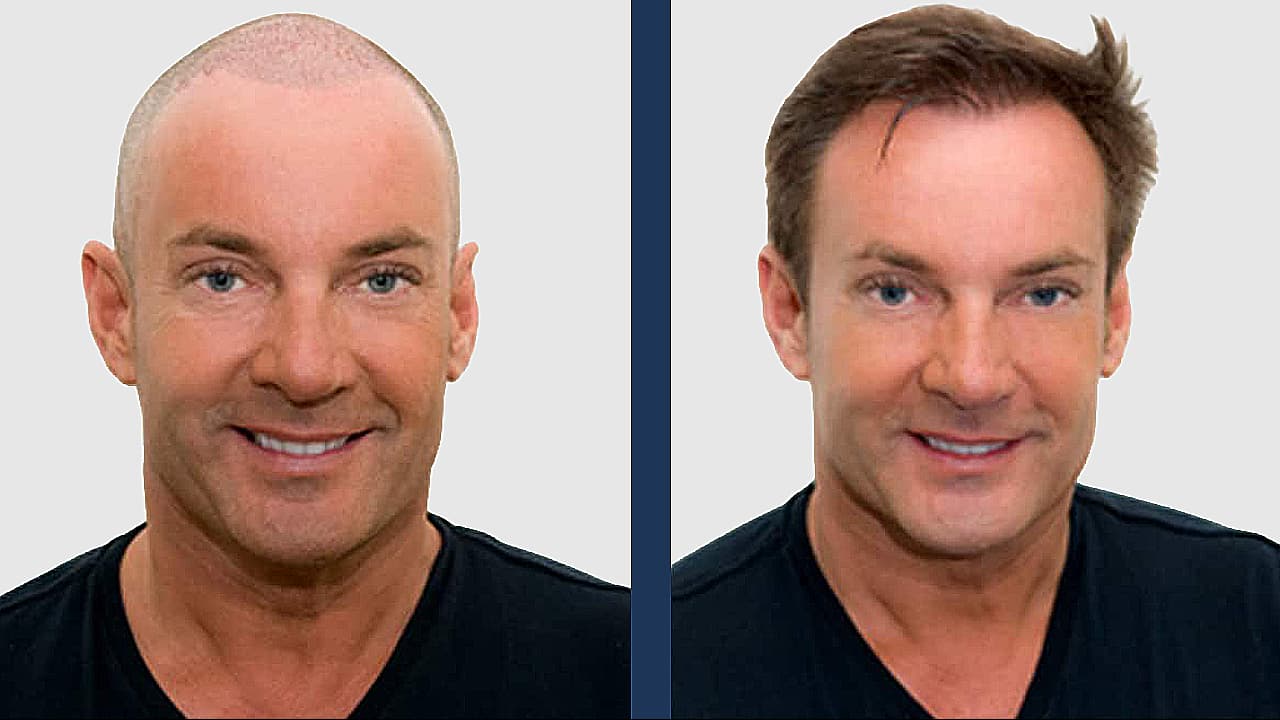 gerard joling voor en na