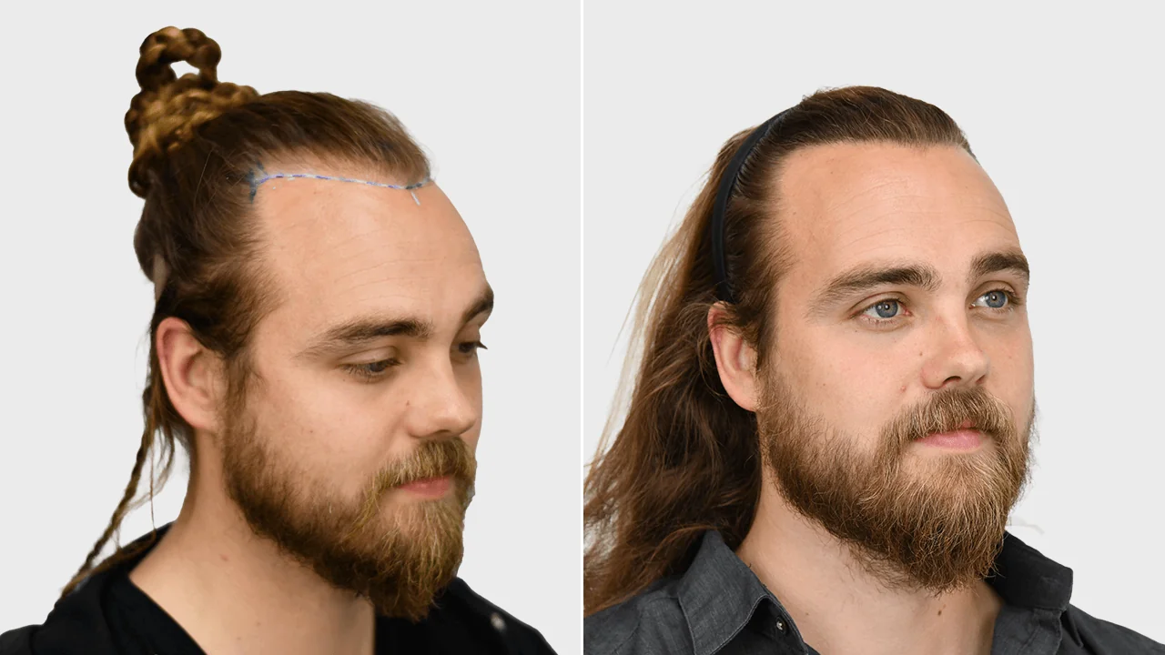 h jorris voor en na rechts