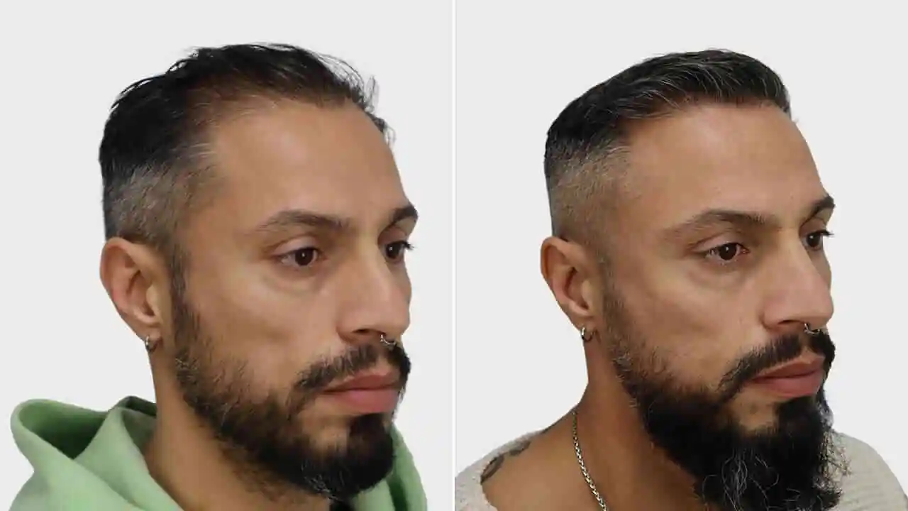 i astitou voor en na rechts