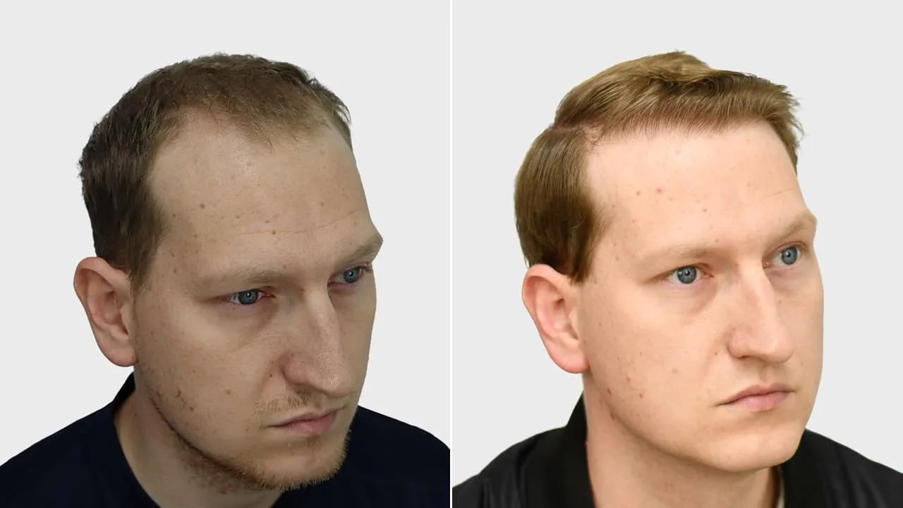 m kuipers voor en na rechts