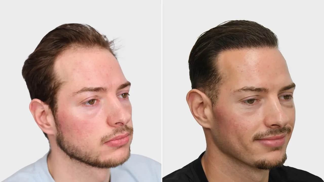 r simoen voor en na rechts