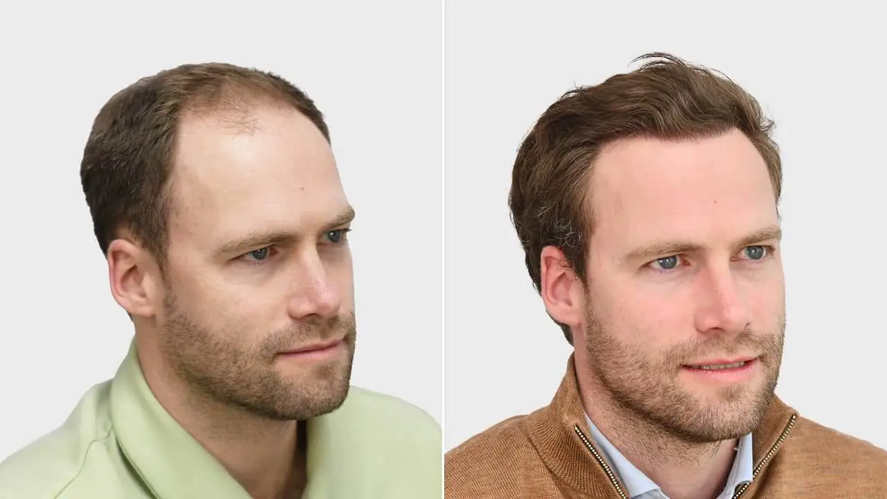 reimer voor en na rechts