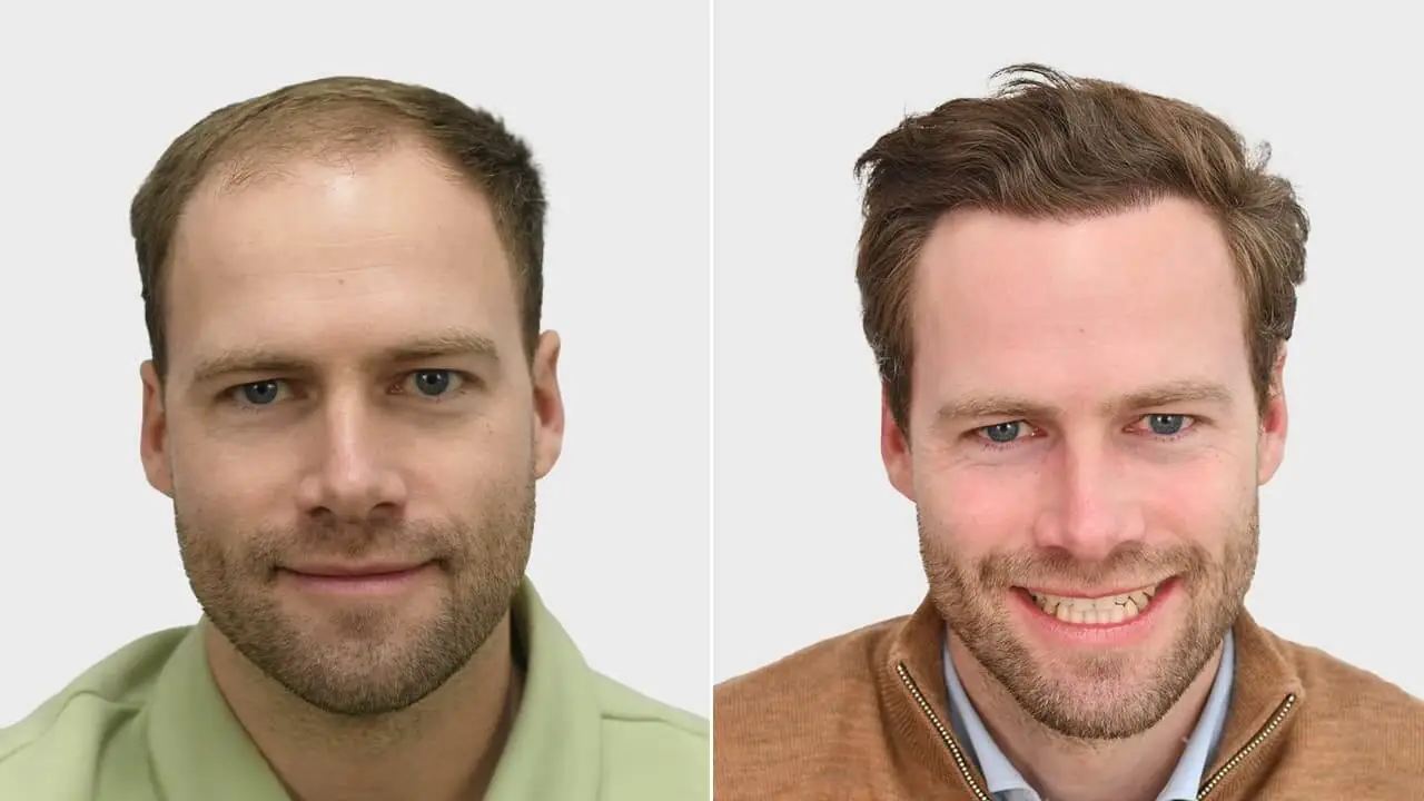 reimer voor en na voorkant
