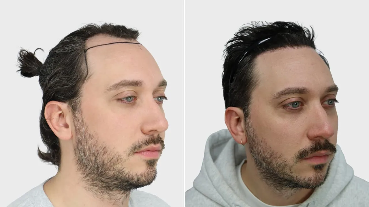 s gorter voor en na rechts