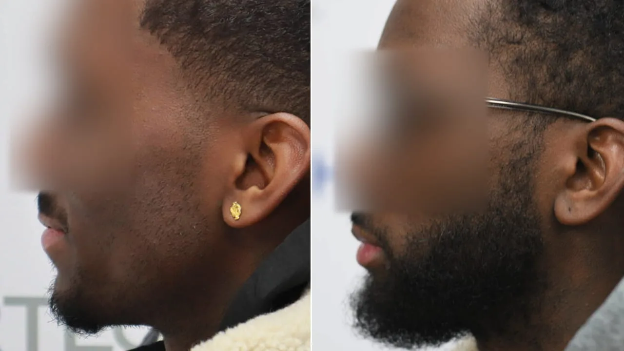 baard en of snor resultaat