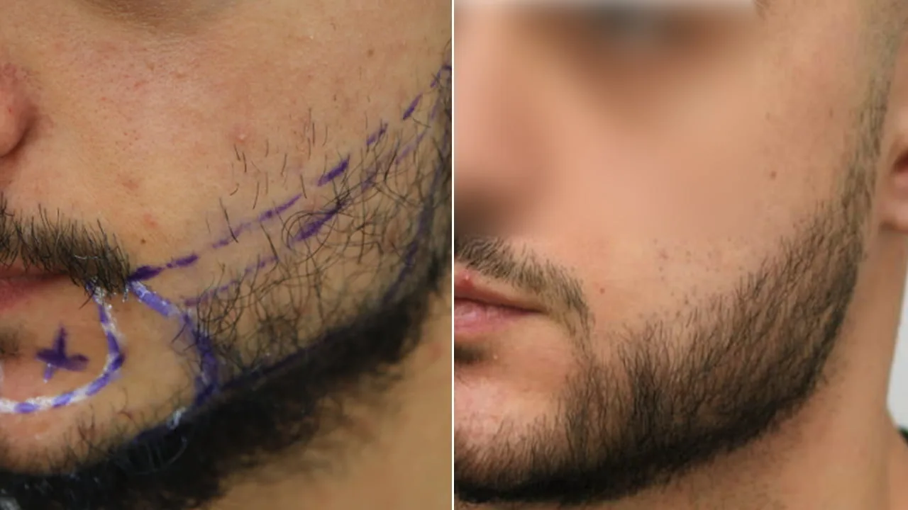baard transplantatie voor en na 2