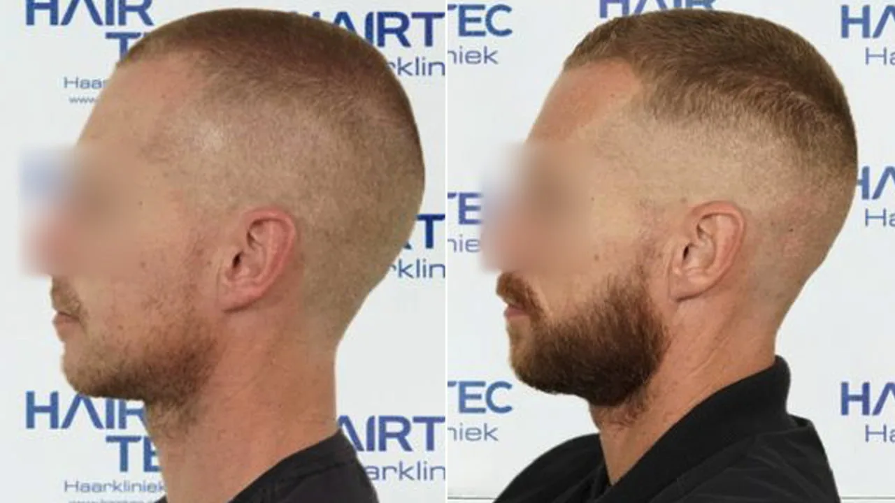 baard transplantatie voor en na 3