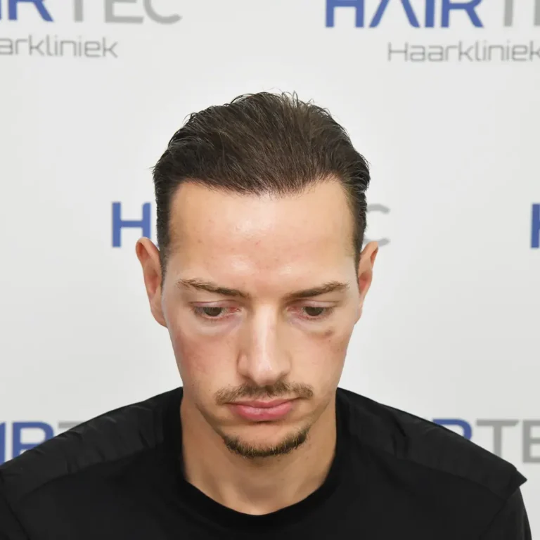 12 maanden na de haartransplantatie, 3.233 grafts
