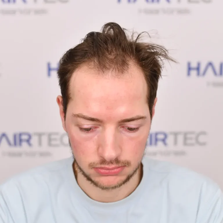 Vóór de haartransplantatie, 3.233 grafts