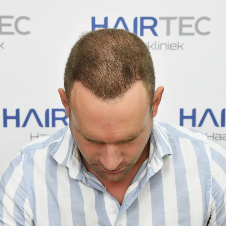 12 maanden na de haartransplantatie, 4.042 grafts