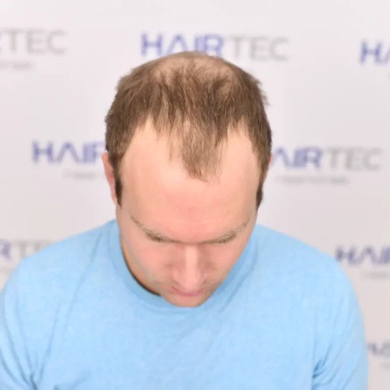 Vóór de haartransplantatie, 4.042 grafts