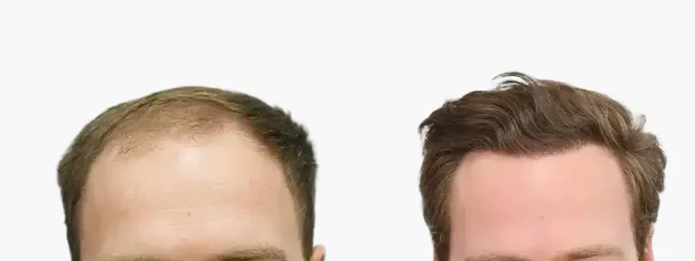 voor en na haartransplantatie desktop