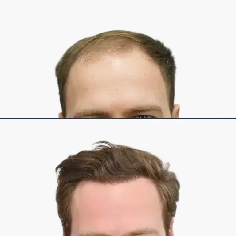 voor en na haartransplantatie mobile