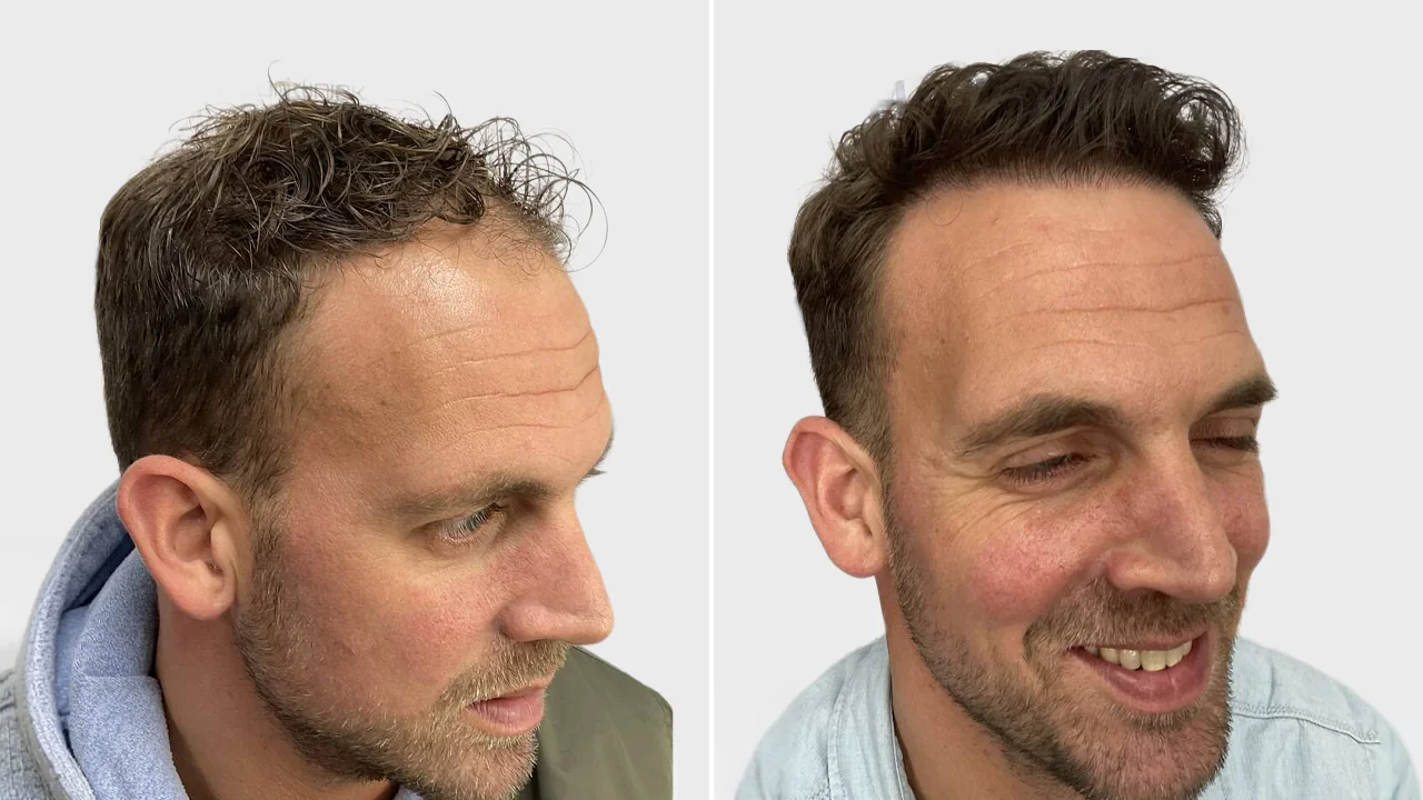 jansen voor na rechts