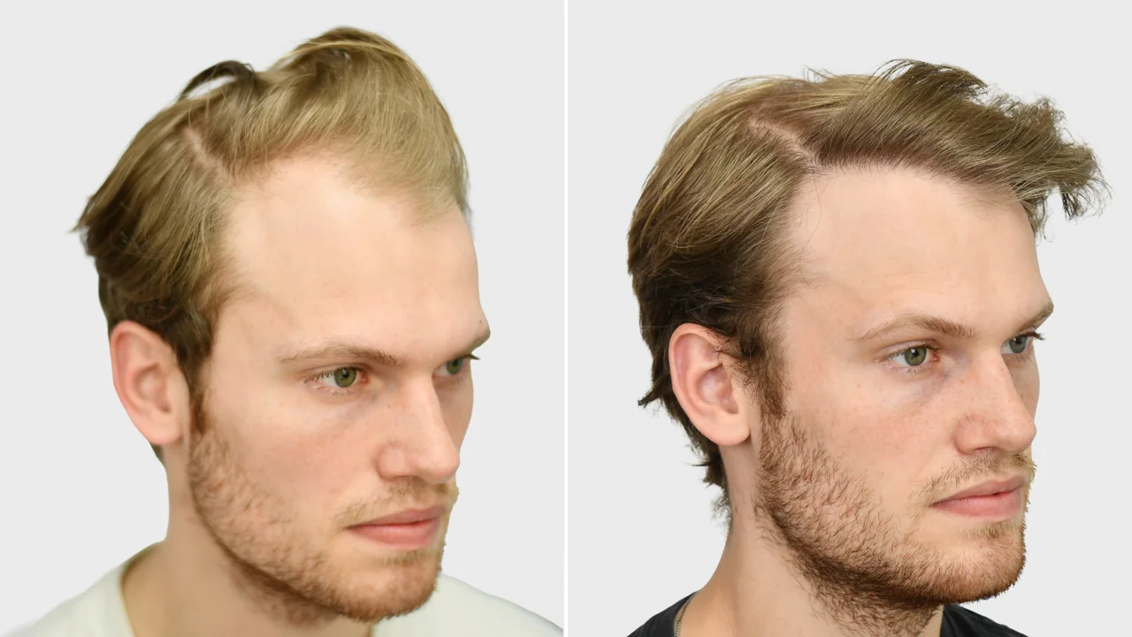 jim voor en na rechts