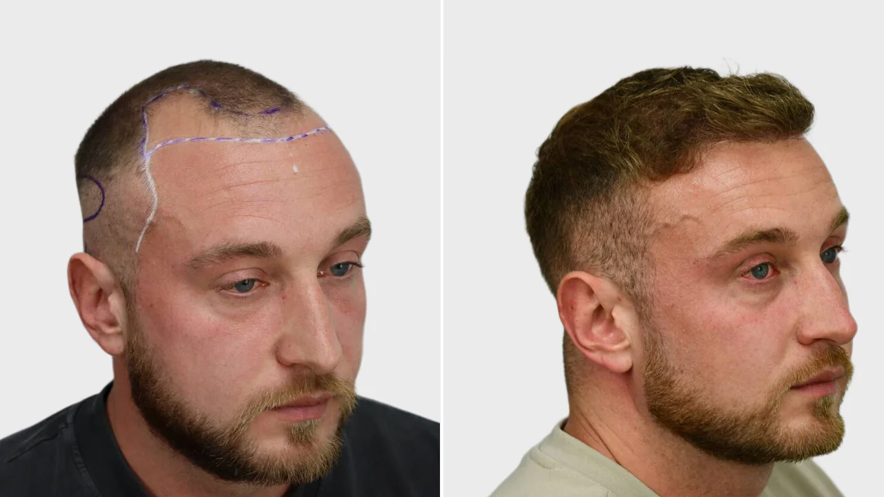 martijn voor na rechts