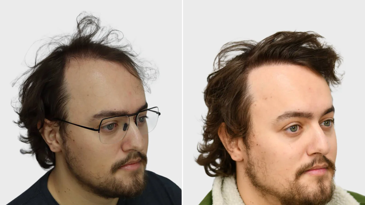 melwin voor en na rechts