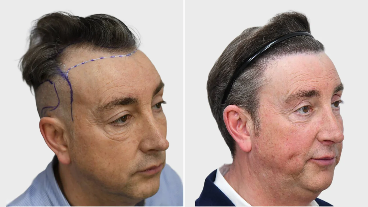 mick voor en na rechts