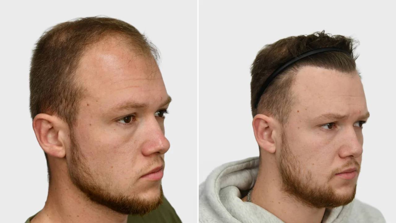 olthof voor en na rechts