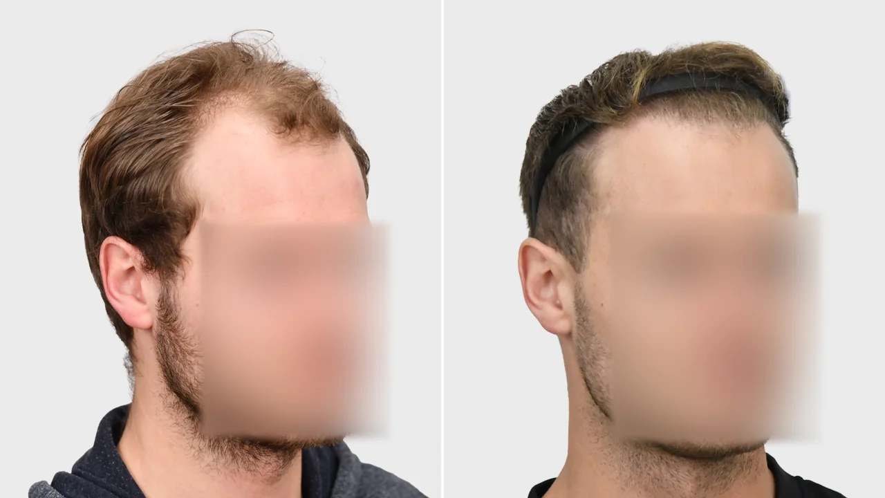 s voor en na rechts