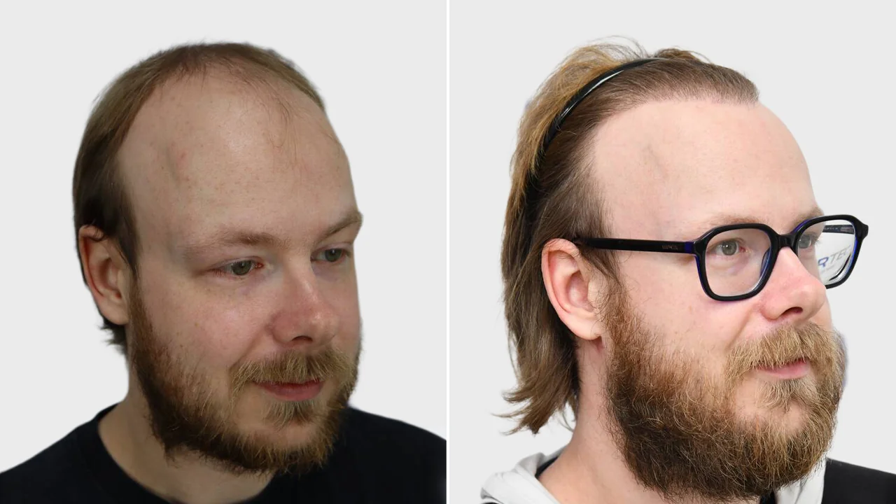 tom voor en na rechts
