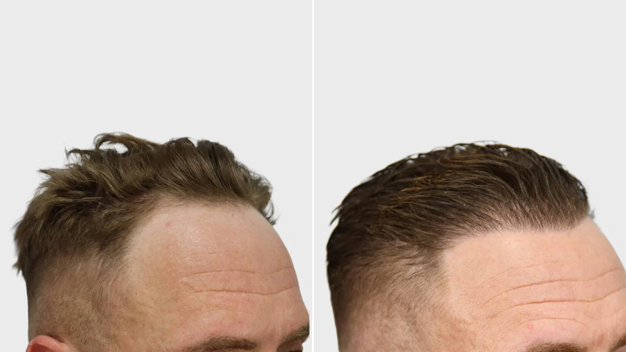w voor en na rechts