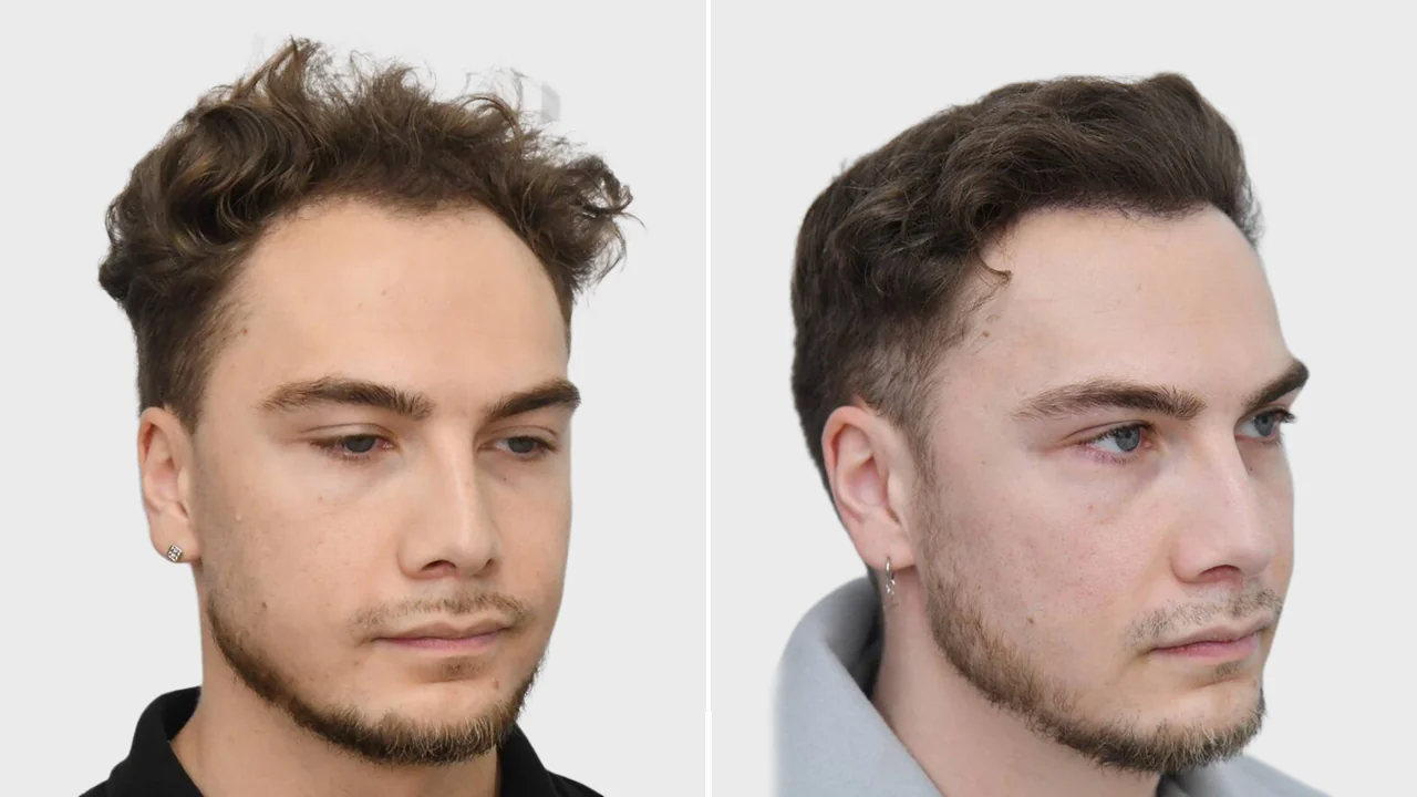 yoel voor en na rechts