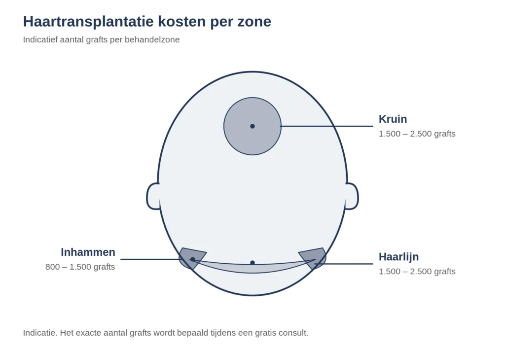 haartransplantatie kosten per zone