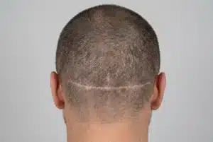 donorgebied na een FUE-haartransplantatie met kleine puntvormige littekens bij kortgeschoren haar