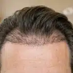 Haargroei na haartransplantatie met nieuwe haren langs de haarlijn.